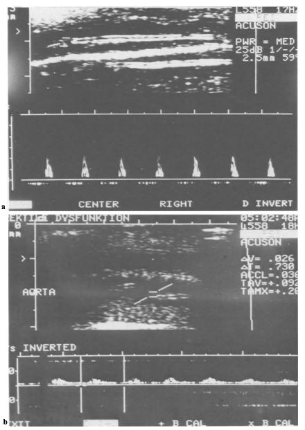 Sonografia duplex convenzionale