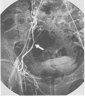 Forte A. epigastrica inferior