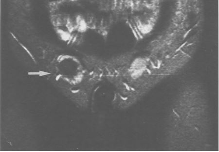 Risonanza magnetica con Maldescensus testis